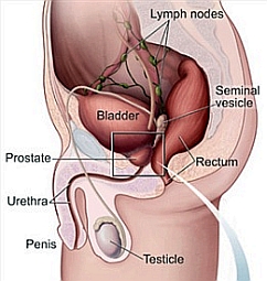 Remedy Prostate Infection Naturally